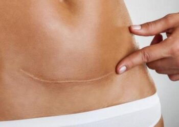 Carski rez: Koje su moguće dugoročne posljedice za majku i dijete?