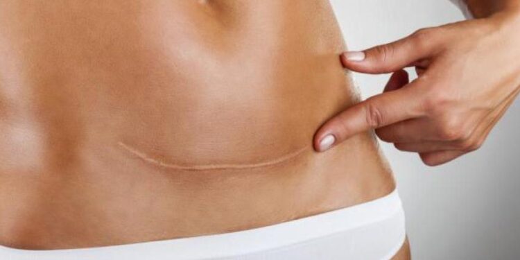 Carski rez: Koje su moguće dugoročne posljedice za majku i dijete?